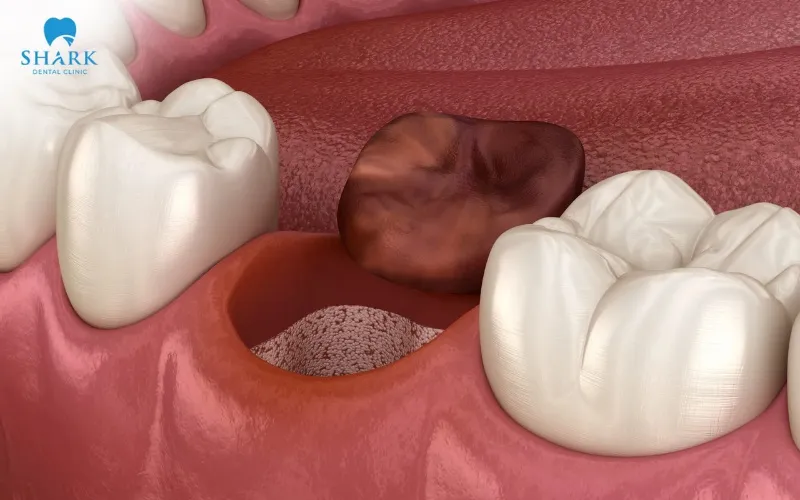 A blood clot has formed and needs to remain stable in the extraction socket to protect the gum tissue and support the healing process during each tooth extraction healing stage