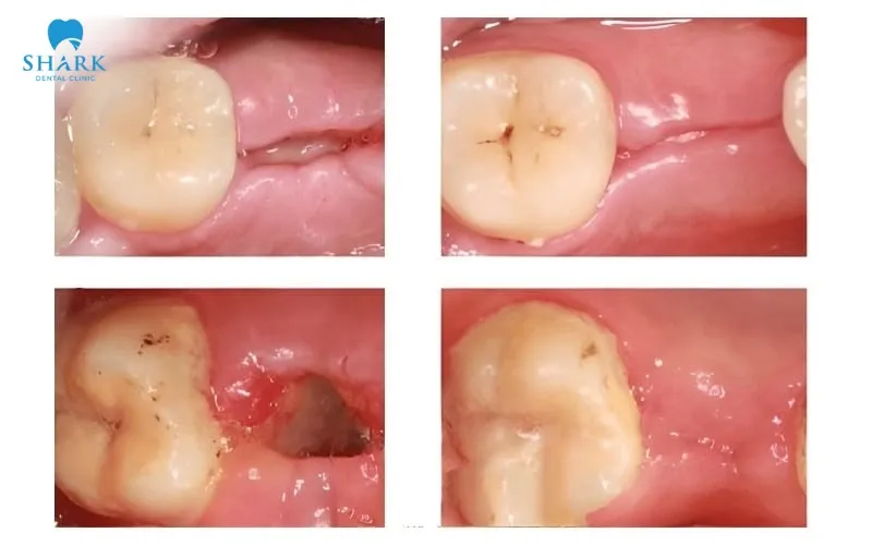 The soft tissue has filled most of the extraction socket, and the gum surface appears flatter and pinker