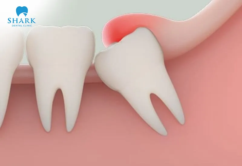 Misaligned wisdom teeth can cause gum swelling, pain, and significant discomfort