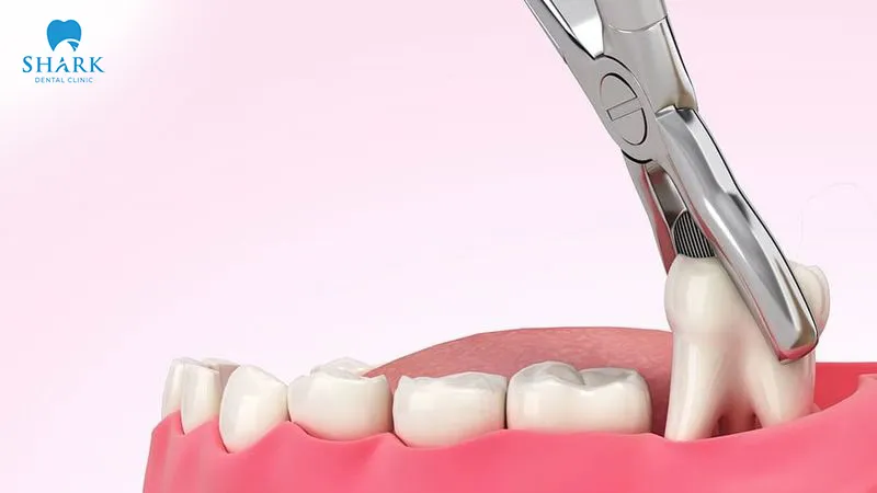 Wisdom tooth extraction is an effective treatment method for teeth that grow misaligned or become impacted