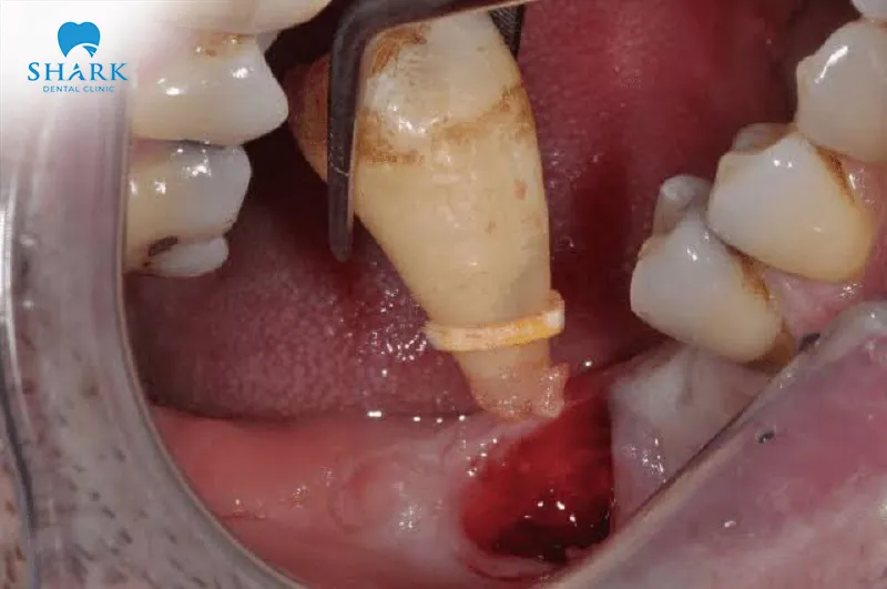 Improper wisdom tooth extraction can lead to various complications and negatively affect oral health