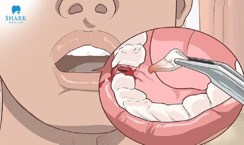 The recovery process after wisdom tooth extraction depends on the individual’s physical condition as well as their post-treatment care