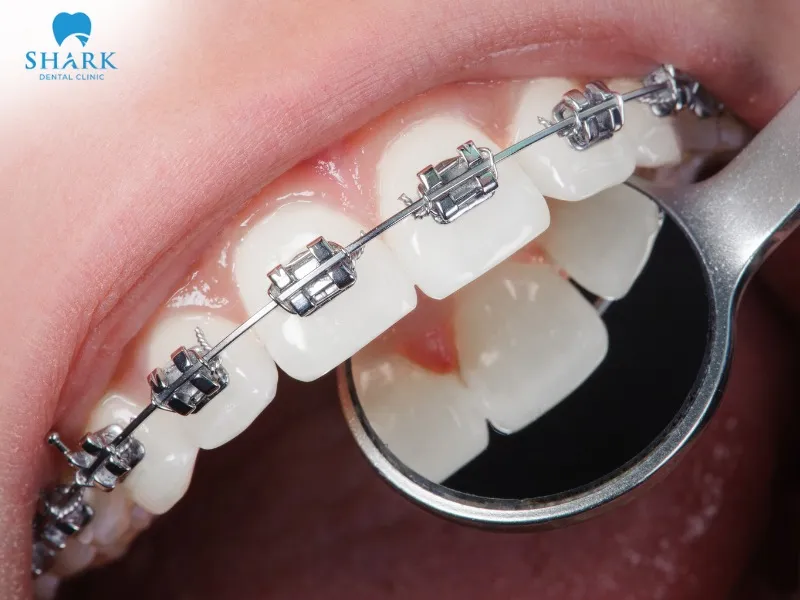 Adults may consider options such as metal braces, ceramic braces, or clear aligners