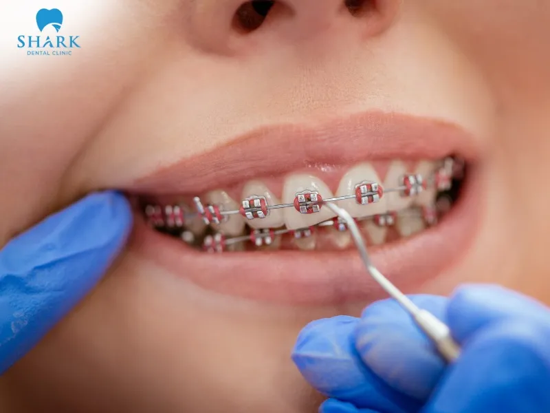 Metal braces are suitable for cases of misaligned, crowded, protruding, or underbite teeth