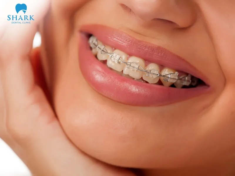 Ceramic braces are made from high-quality ceramic materials, typically transparent or tooth-colored