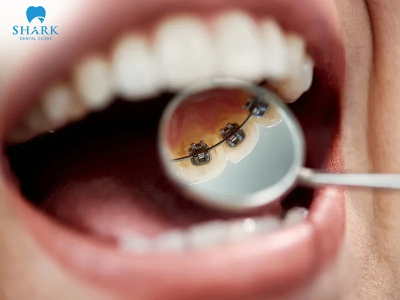 Lingual braces (placed on the inner surface of the teeth) offer optimal and efficient orthodontic results