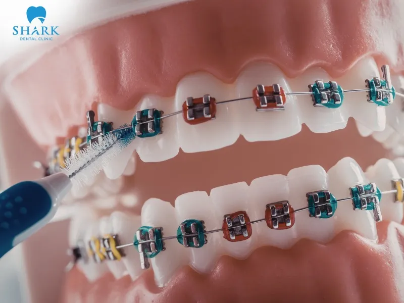 Self-ligating braces use archwires and brackets designed with an automatic sliding mechanism