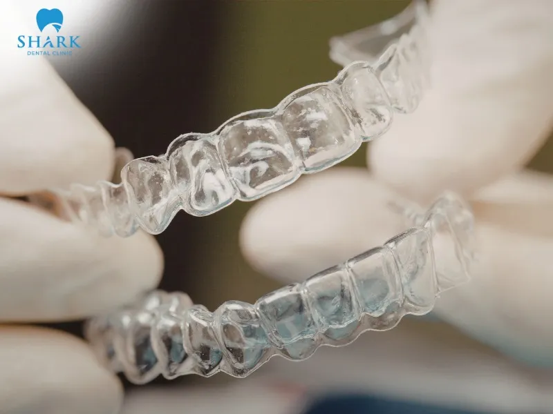 Clear aligner braces provide high aesthetics and can be easily removed for cleaning