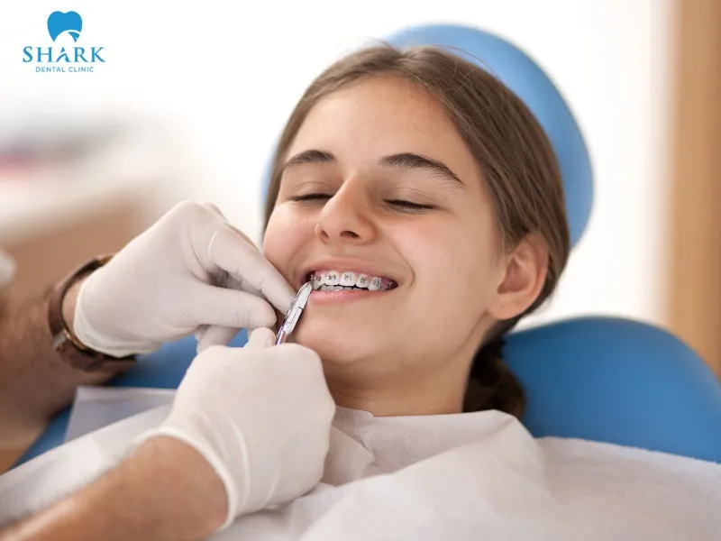 Based on your dental condition and personal needs, you can choose the most suitable option among the types of braces for adults