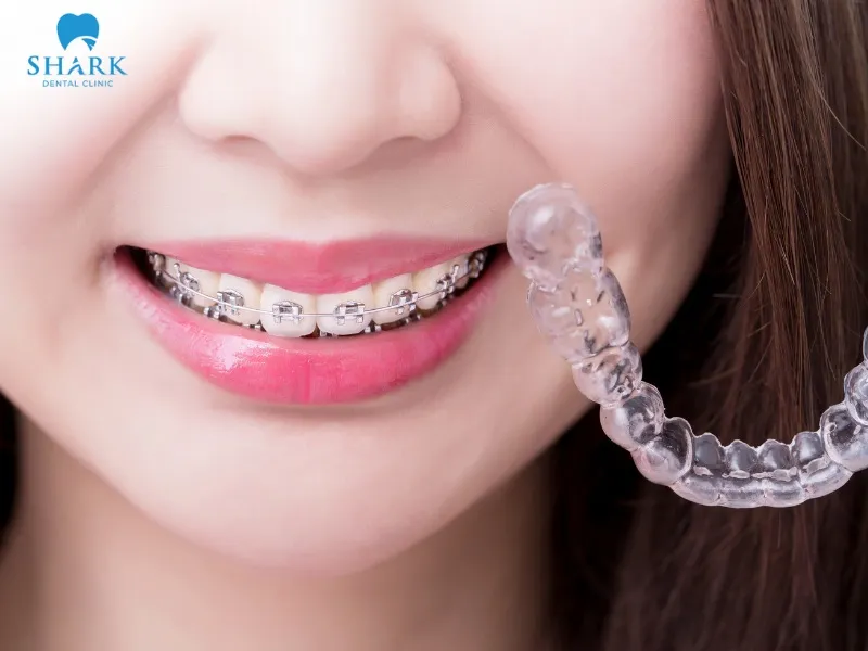 Adults usually wear teeth braces for adults for approximately 12–36 months, depending on the severity of misalignment and the dentist’s recommendations