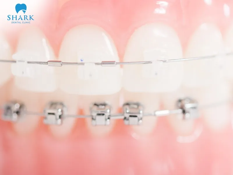 The periodontal ligament plays an important role in absorbing pressure from orthodontic forces, creating favorable conditions for tooth movement