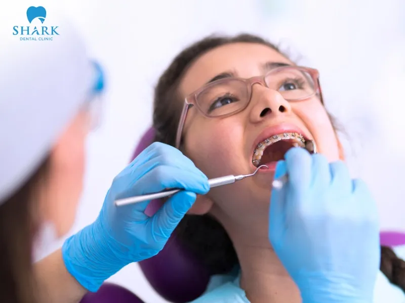 The dental arch may require approximately 6 months to 1 year to become strong and stable again