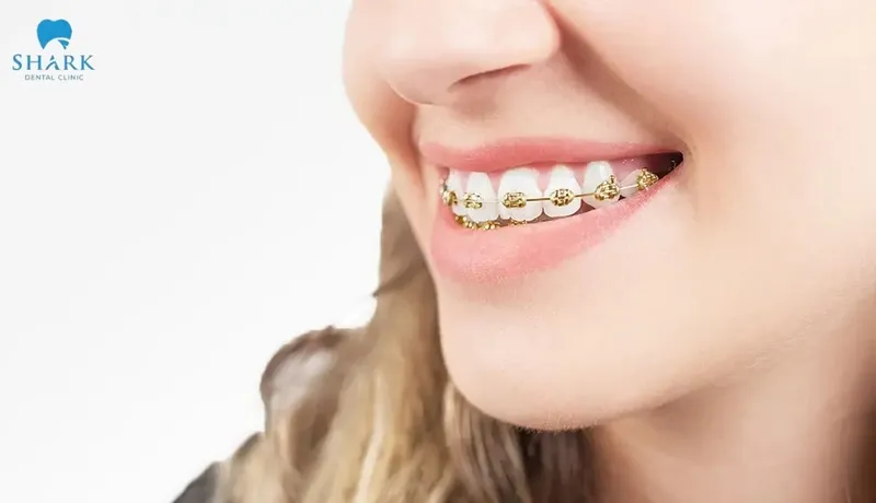 Gold metal braces offer many outstanding advantages in terms of durability and aesthetics