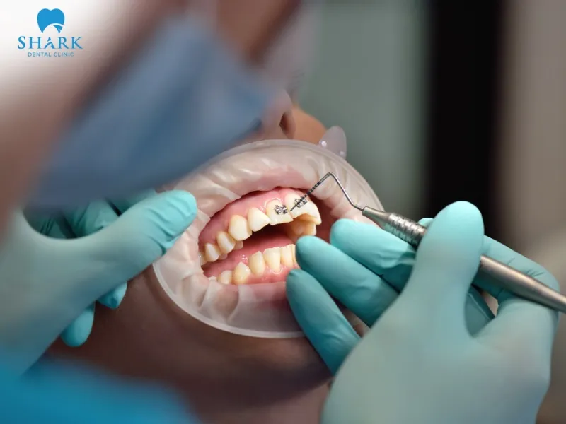 On average, it takes about 6–12 months for gaps between teeth to be noticeably closed