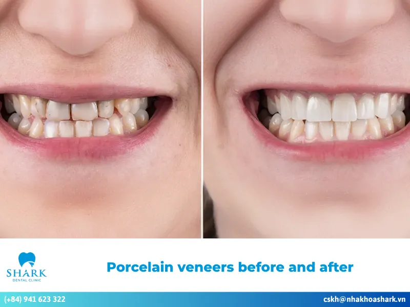 porcelain veneers before and after