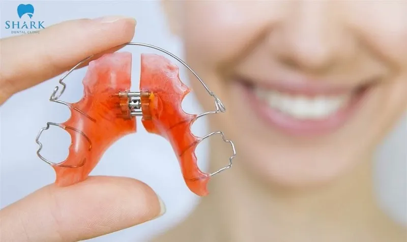 You need to strictly follow your dentist’s instructions and wear your retainer regularly during the first 6 months
