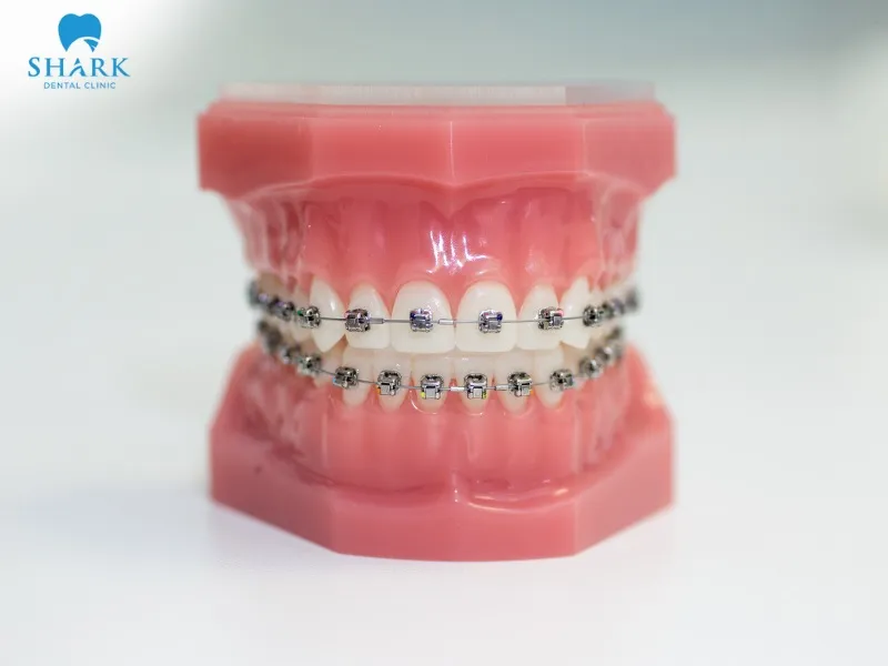 You should pay attention to proper brushing techniques and brush gently while wearing braces