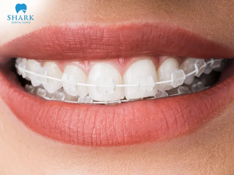 Ceramic braces are a modern orthodontic method and are widely favored today