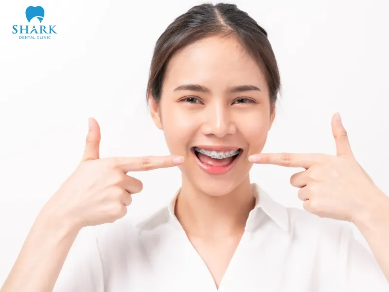 Individuals who frequently communicate in professional or social settings, or those who are allergic to metal, should consider ceramic braces