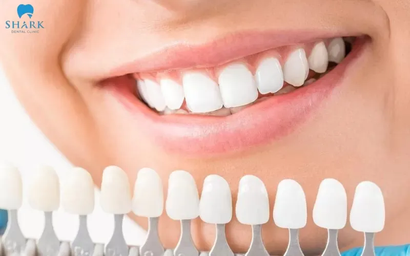 Composite veneers are commonly chosen by many patients because they possess several notable advantages in cosmetic dental restoration