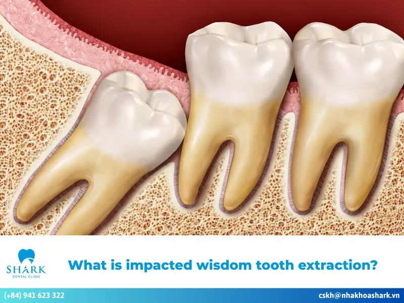 Impacted wisdom tooth extraction