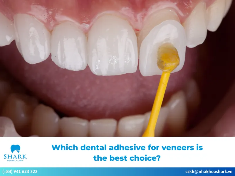 Which dental adhesive for veneers is the best choice?