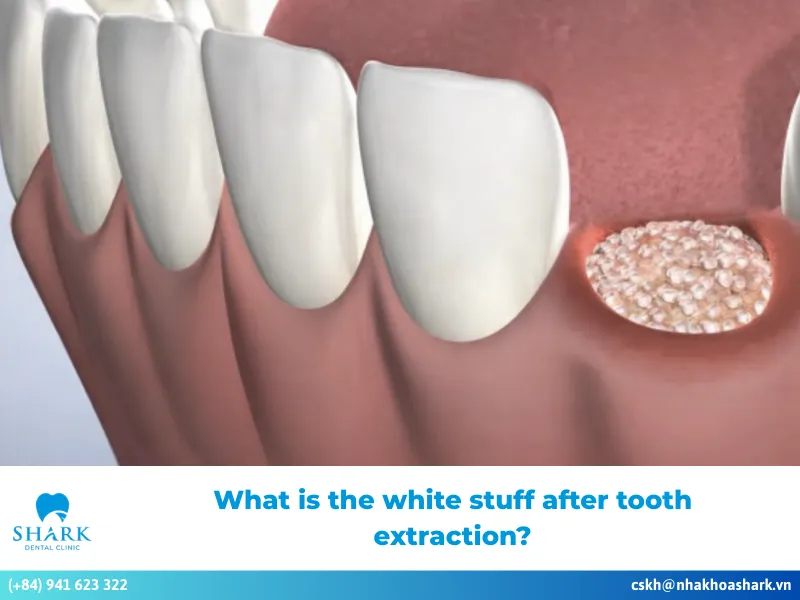What is the white stuff after tooth extraction?