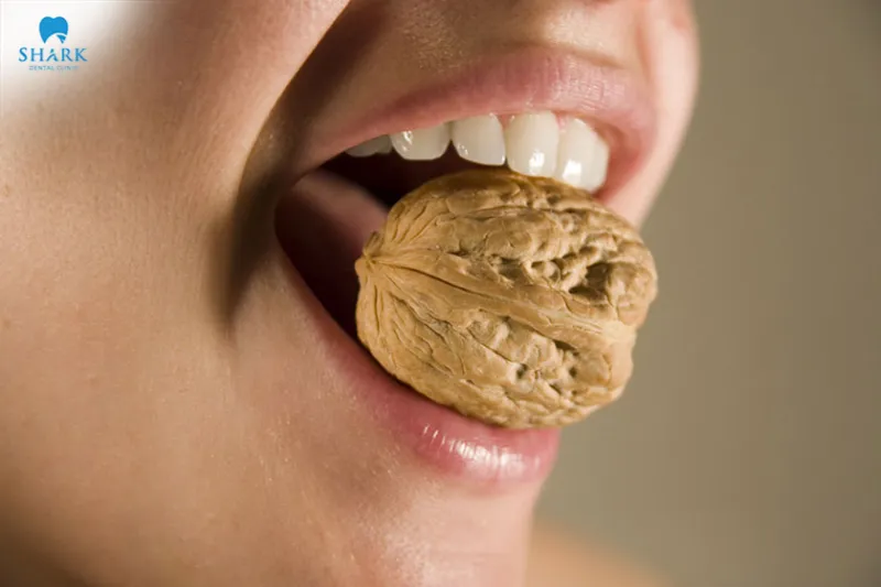 After getting dental veneers, avoid foods that are too hard or too chewy, as they can place excessive pressure on the veneers and impact their durability