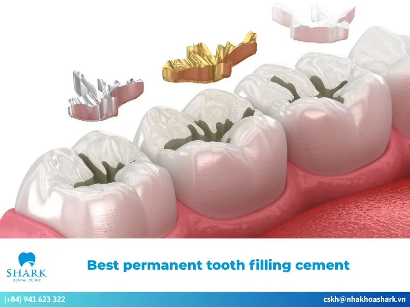 What is the best permanent tooth filling cement? Common types