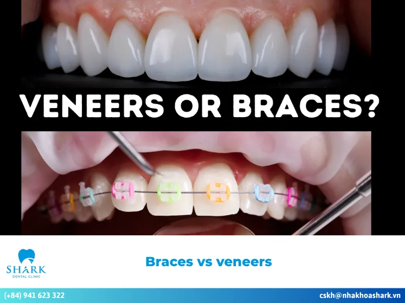 Braces vs veneers: When should you choose braces or veneers?