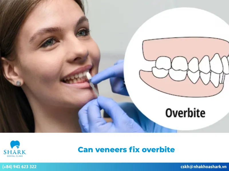 Can veneers fix overbite? Methods to improve an overbite