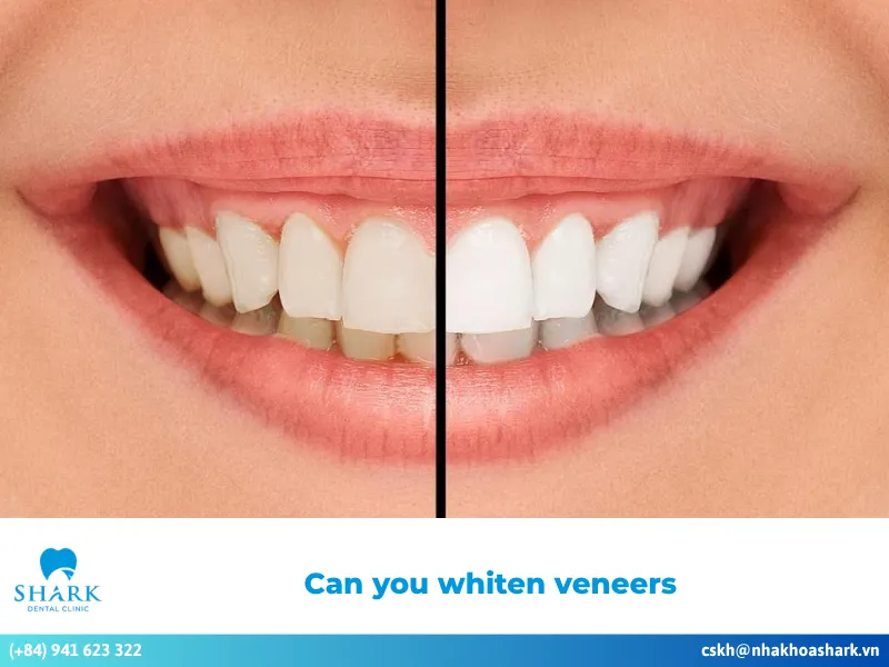 Can you whiten veneers? Ways to prevent discoloration