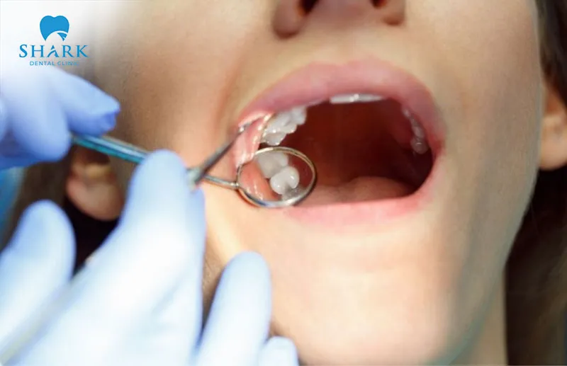 Depending on each specific case, the dentist will carefully evaluate and provide appropriate instructions both before and after wisdom tooth extraction