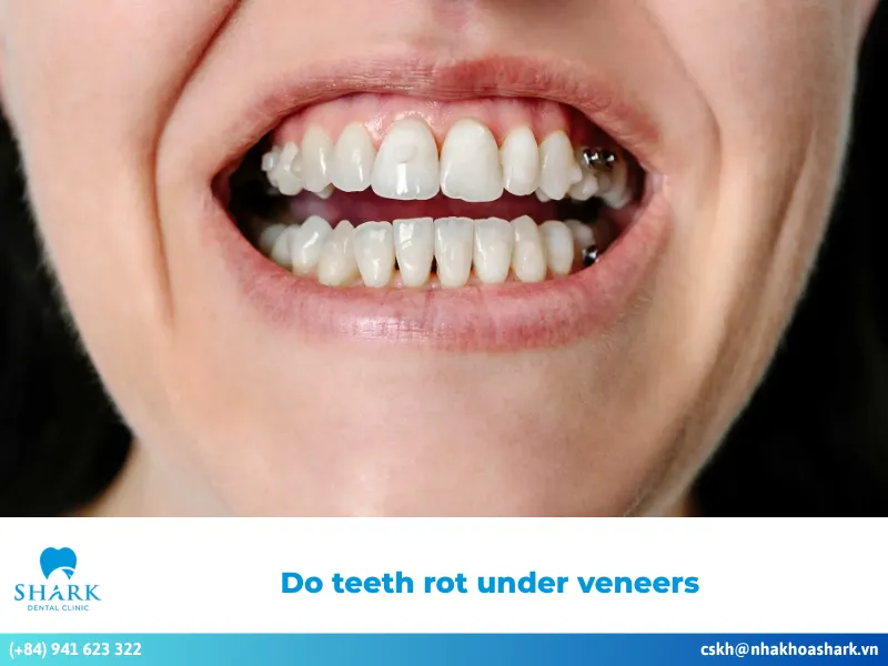 Do teeth rot under veneers? How can it be addressed?