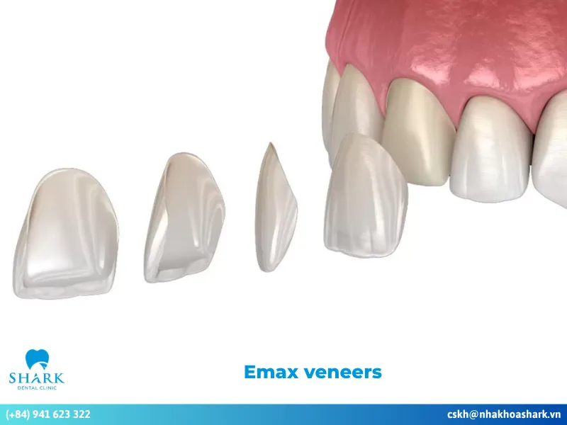 What are emax veneers? Benefit vs limitation you need to know