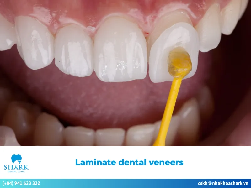 Laminate dental veneers and information you need to know