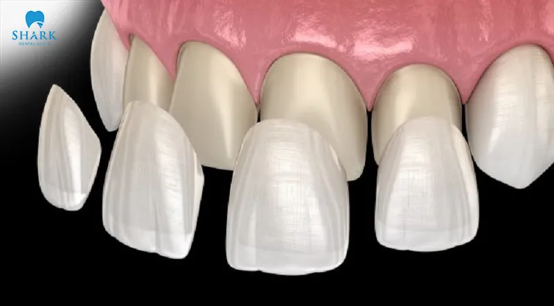 Laminate veneers are also highly appreciated for their durability and ability to withstand significant biting forces over time