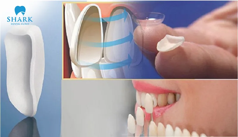 Laminate porcelain veneers are suitable for cases where teeth have mild imperfections or minor aesthetic issues