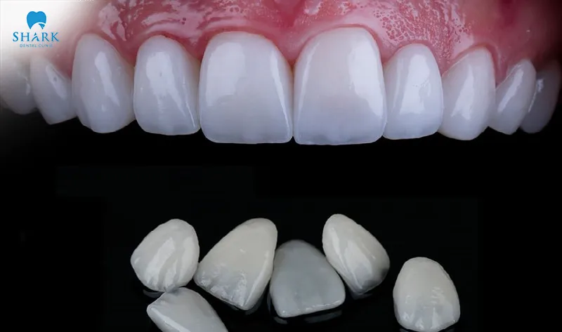 The cost of laminate porcelain veneers may vary depending on each dental clinic and the level of service provided
