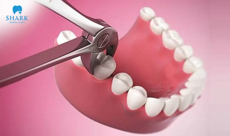 There are many factors that can influence the level of pain after tooth extraction, such as the dentist’s skill, the treatment process, post-extraction care, and each individual’s physical condition