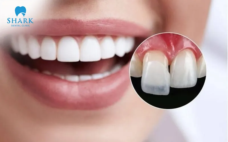 Veneers offer high safety and durability, making them a reliable aesthetic dental solution