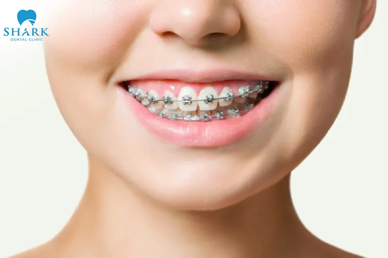 Braces work by applying controlled force to gradually move teeth into their desired positions on the dental arch