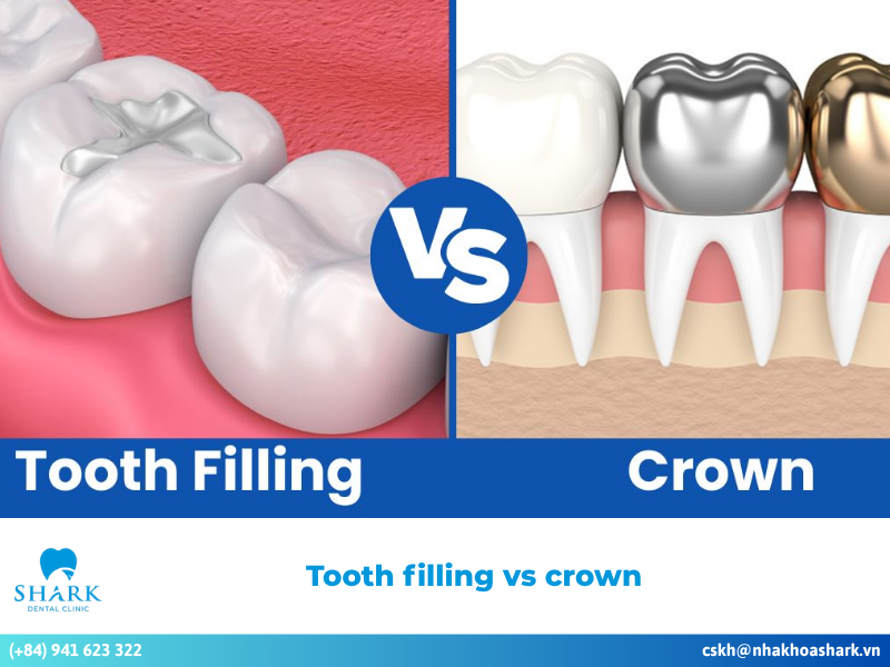 Tooth filling vs crown: Which method is suitable for you?