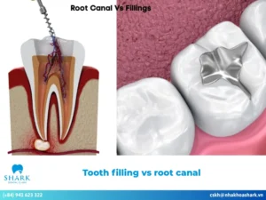 Tooth filling vs root canal: Advantages, disadvantages, and cost