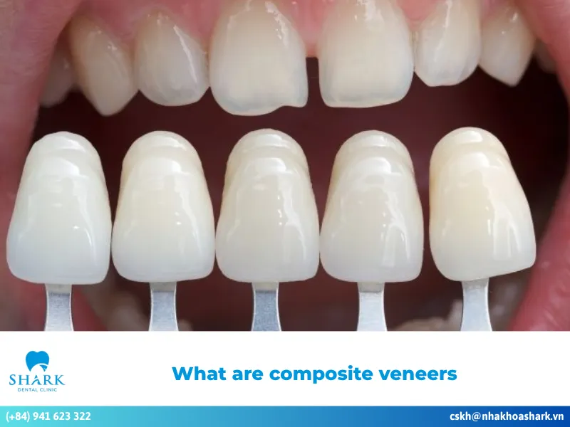 What are composite veneers? Everything you need to know