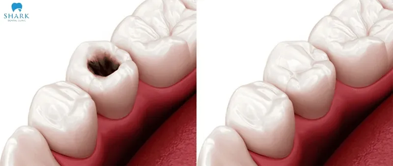 The lifespan of a filling created using an at-home filling kit typically lasts around 1 to 4 weeks, depending on the condition and usage