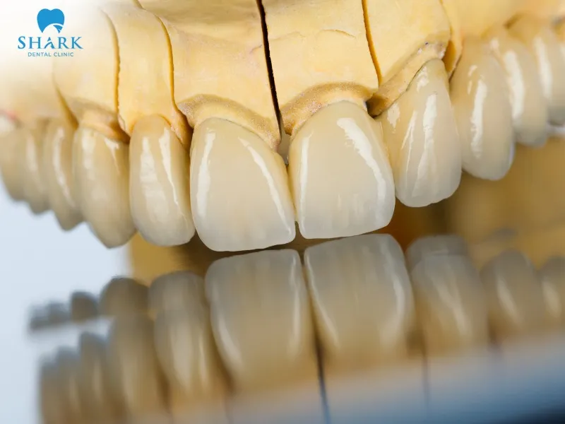 Some types of veneers with lower stain resistance may become dull or yellow over time with regular use