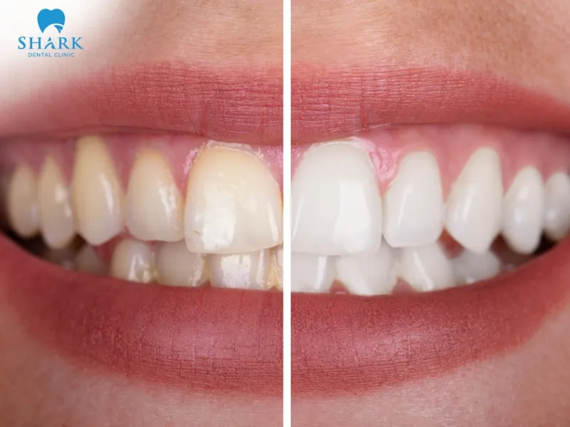Veneer discoloration may be caused by exposure to foods and beverages, gum recession, or the original shade of the veneers