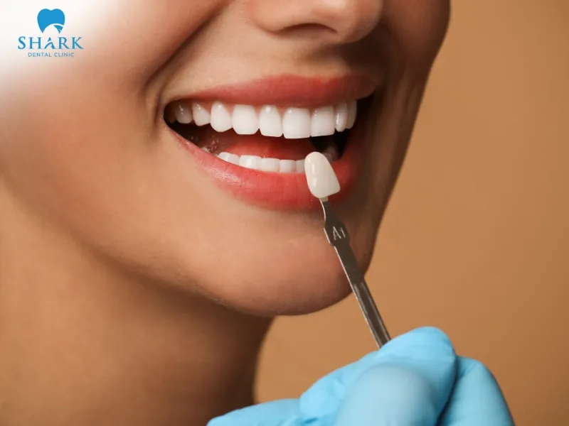 Lithium disilicate veneers are resistant to discoloration and do not easily become stained, yellowed, or dull over time with proper care