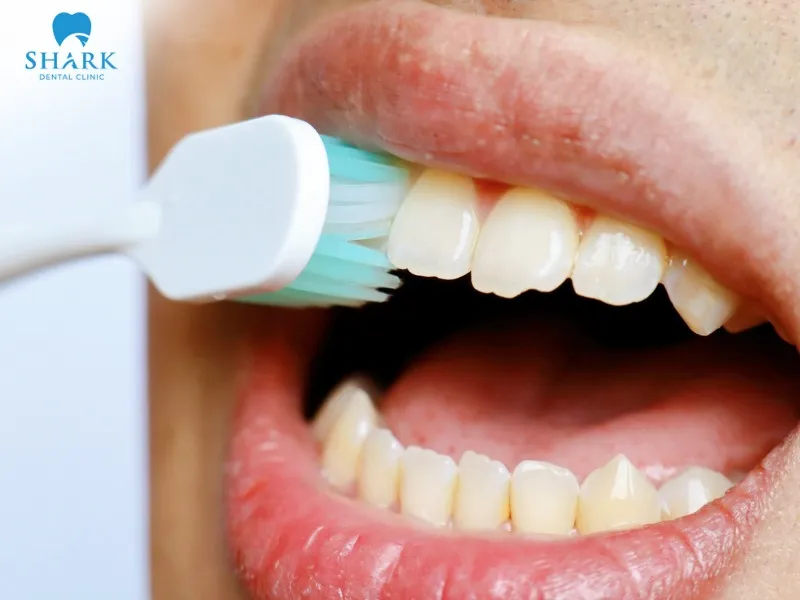 You need to brush your teeth gently using a soft-bristled toothbrush to avoid affecting the healing area or causing irritation